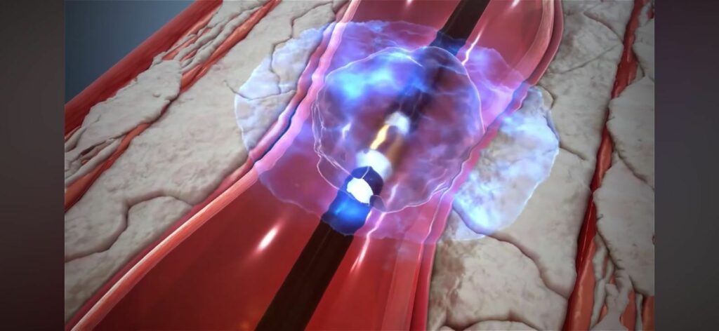 Cirurgia vascular para prevenir AVC é realizada pela primeira vez