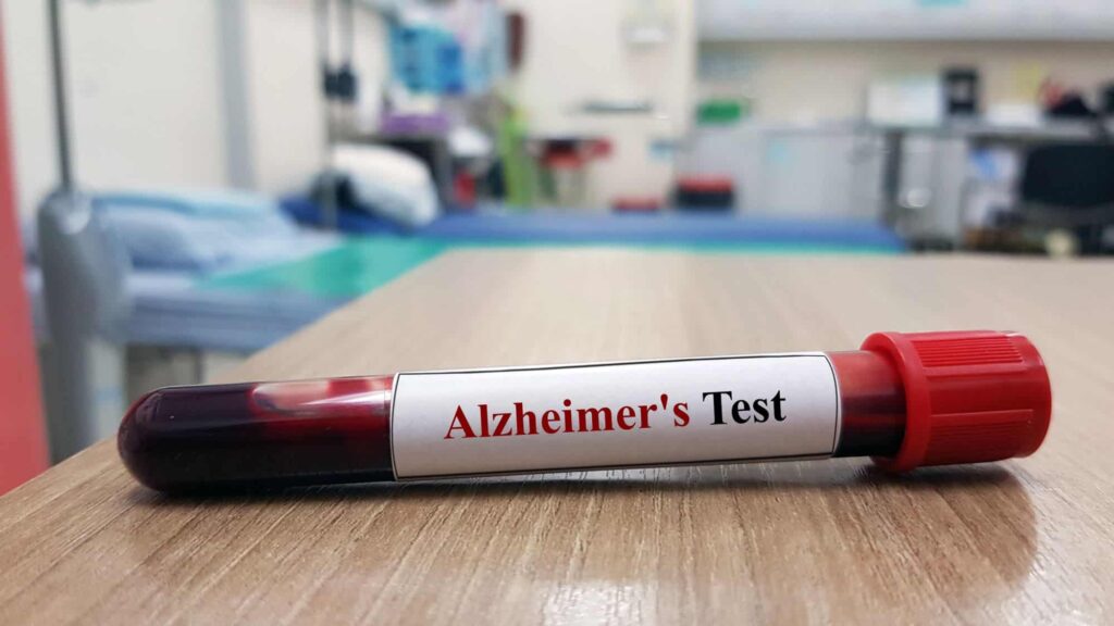 Exames de sangue podem ajudar no diagnóstico precoce do Alzheimer