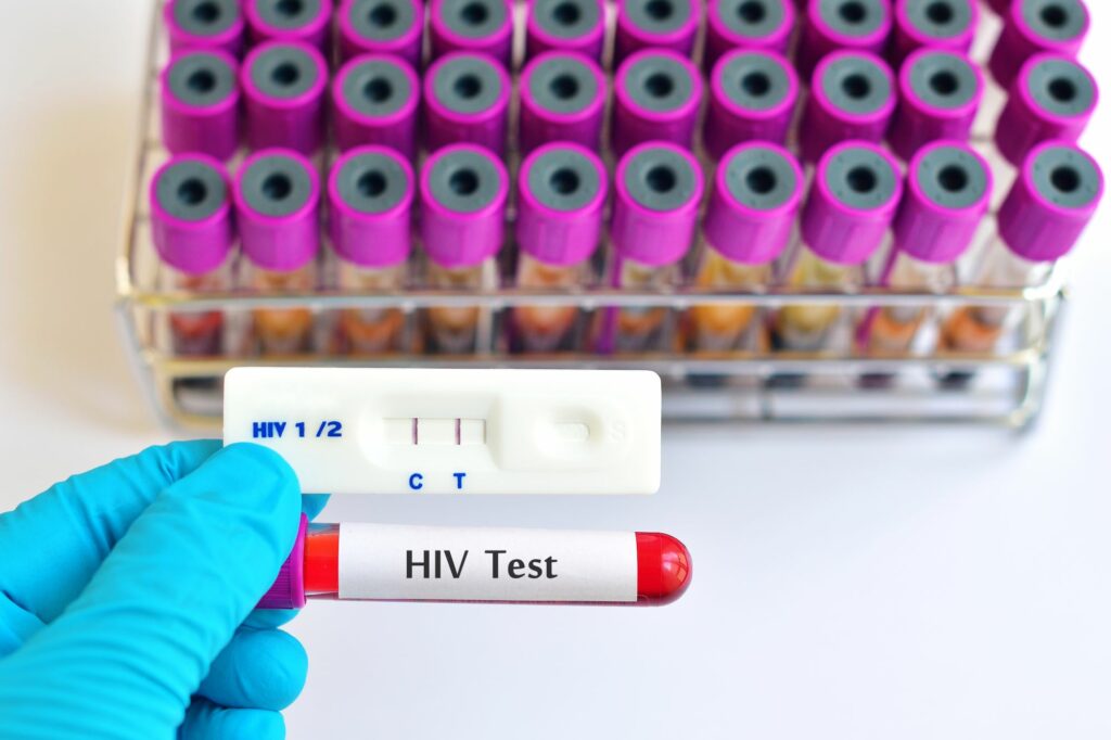 Nova variante do HIV é identificada em três estados brasileiros