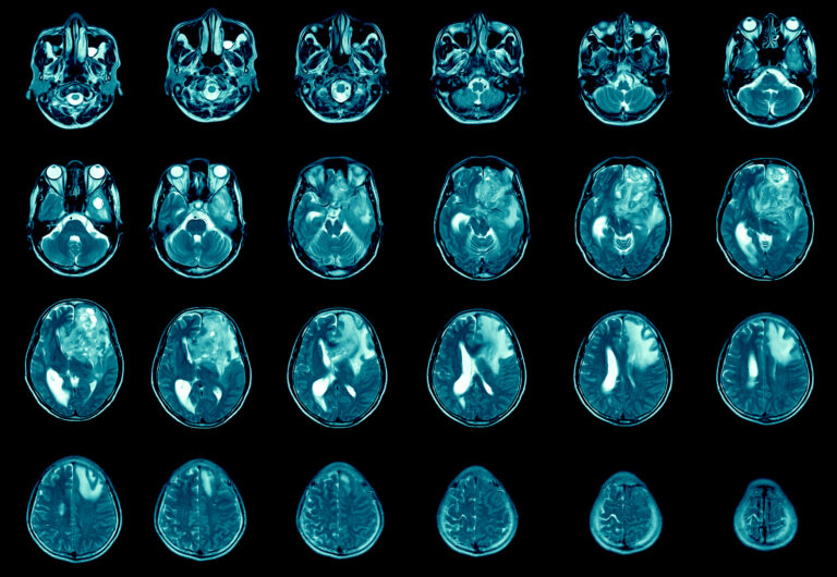 Antidepressivo mostra potencial no tratamento de câncer incurável