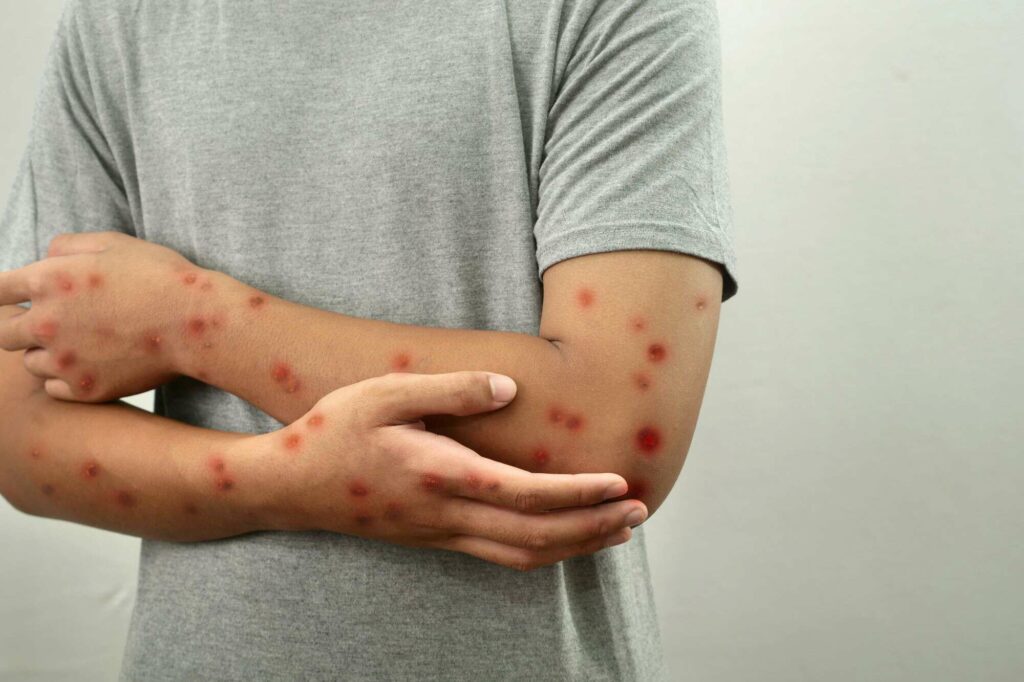 Calor pode aumentar casos de mpox? Especialista responde