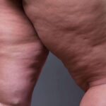 Por que o lipedema é mais comum em mulheres? Entenda