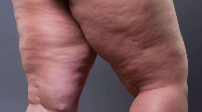 Por que o lipedema é mais comum em mulheres? Entenda