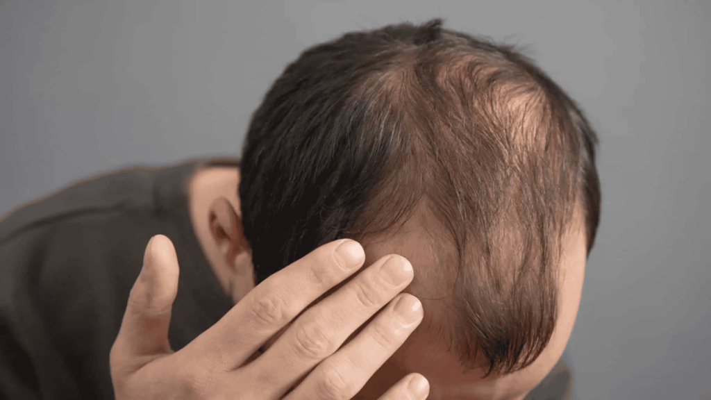 Uma dieta bem comum está ligada à queda de cabelo,