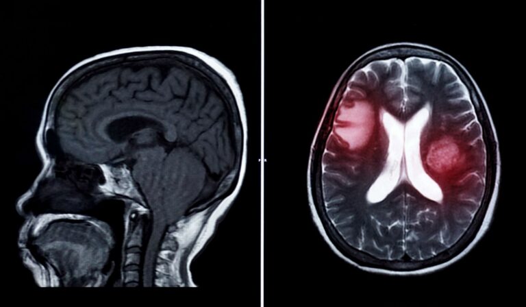 Você tem 3% de chance de ter um aneurisma cerebral