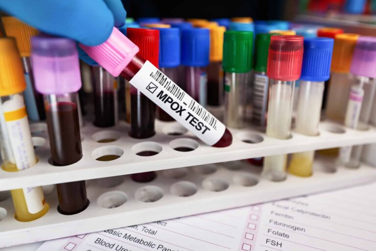 Mpox: SP registra primeira ocorrência de nova cepa no Brasil