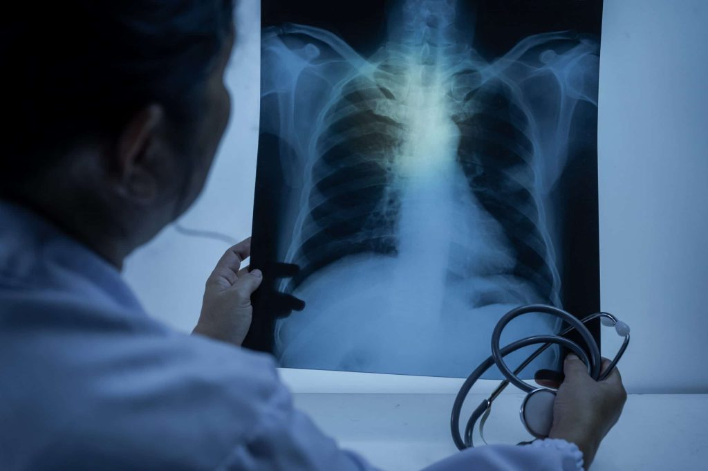 O que é o pneumotórax? Conheça os sintomas dessa doença