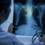 O que é o pneumotórax? Conheça os sintomas dessa doença