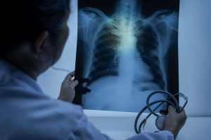 O que é o pneumotórax? Conheça os sintomas dessa doença