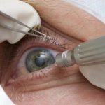 Cirurgia que altera cor do olho tem uso restrito para