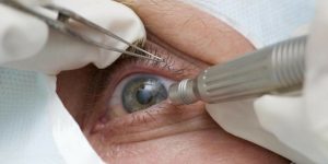 Cirurgia que altera cor do olho tem uso restrito para
