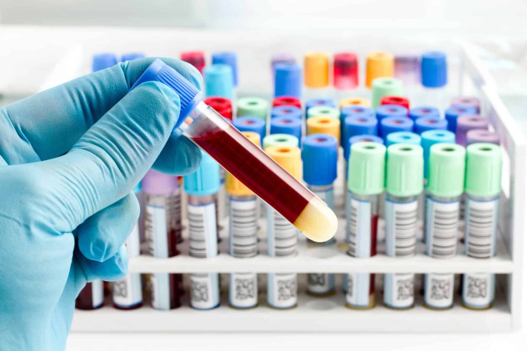 Estudo: Dependendo do tipo sanguíneo, chances de AVC podem ser