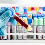 Estudo: Dependendo do tipo sanguíneo, chances de AVC podem ser