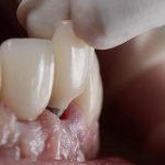 Implante dentário “inteligente” promete devolver sensibilidade ao sorriso