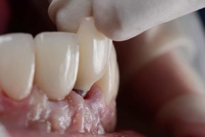 Implante dentário “inteligente” promete devolver sensibilidade ao sorriso