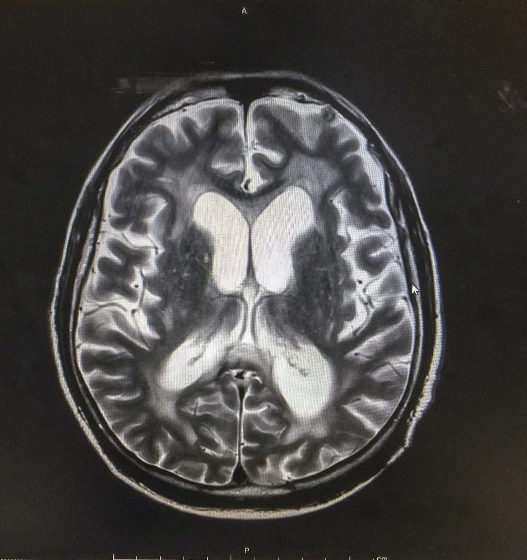 Implante no cérebro? Entenda como é a cirurgia de Chico