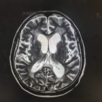 Implante no cérebro? Entenda como é a cirurgia de Chico