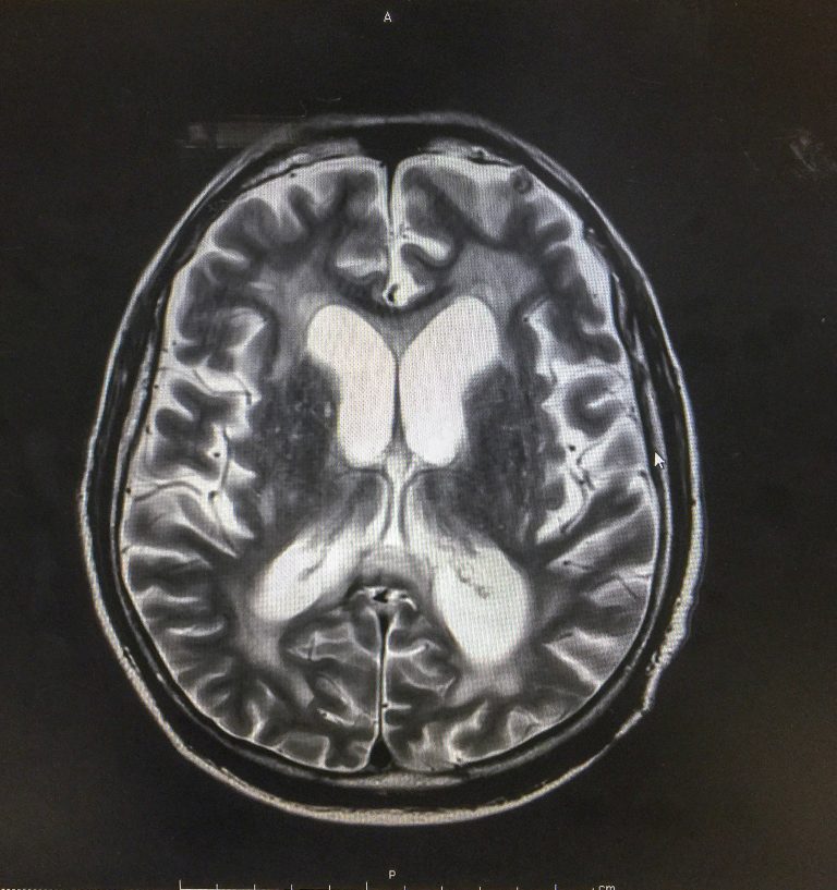 Implante no cérebro? Entenda como é a cirurgia de Chico