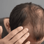 Finalmente? Cura para calvície pode ter sido descoberta
