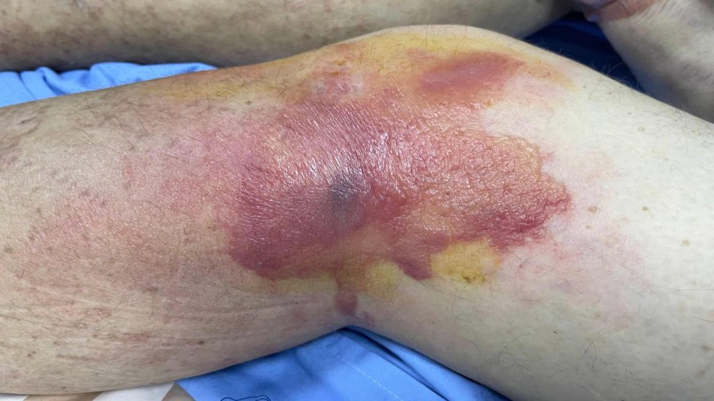 O que é celulite infecciosa? Conheça sintomas e formas de