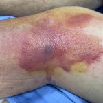 O que é celulite infecciosa? Conheça sintomas e formas de