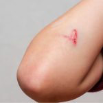 Como uma ferida no corpo se cura “sozinha”? Descubra o