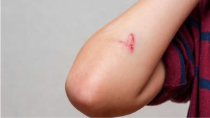 Como uma ferida no corpo se cura “sozinha”? Descubra o