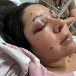 Enfermeira maranhense sobrevive a tiro no rosto dado pelo ex-companheiro
