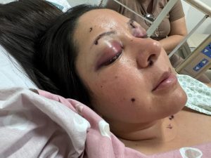 Enfermeira maranhense sobrevive a tiro no rosto dado pelo ex-companheiro