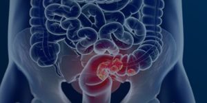 Estudo projeta aumento de 36% em mortes por câncer colorretal