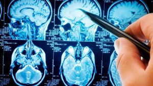 Novo método reverte sintomas de demência em testes