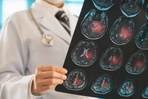 AVC mata um brasileiro a cada seis minutos; 80% dos