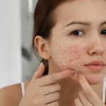 Fim da acne? Vacinas estão a caminho!