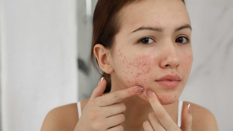 Fim da acne? Vacinas estão a caminho!