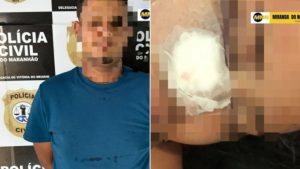 Homem é preso suspeito de atirar no rosto de ex-namorada