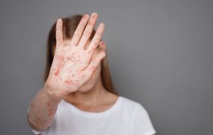 Saúde alerta para casos de sarampo e queda na vacinação