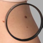 IA que ‘enxerga além da imagem’ detecta câncer de pele