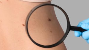 IA que ‘enxerga além da imagem’ detecta câncer de pele