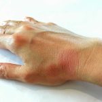 Vírus comum pode ser a chave do lúpus, dizem cientistas