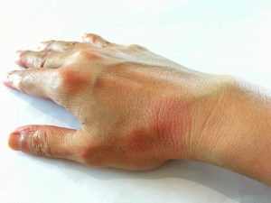 Vírus comum pode ser a chave do lúpus, dizem cientistas