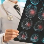 Brasil investiga fatores genéticos que influenciam risco de AVC