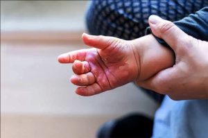 Maranhão registra mais de 120 casos de queimaduras em crianças