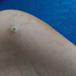 O que é o bicho de pé e como tirá-lo?