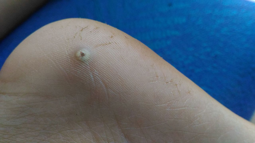 O que é o bicho de pé e como tirá-lo?