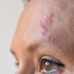 Ministério da Saúde nega incorporação da vacina contra Herpes-Zóster por